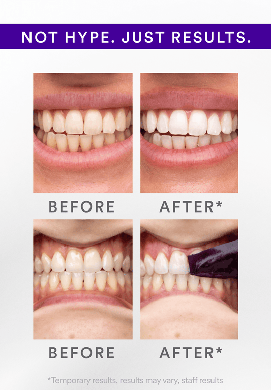 SmileBright™ Violet Strips – Direct zichtbaar wittere tanden, zonder peroxide!