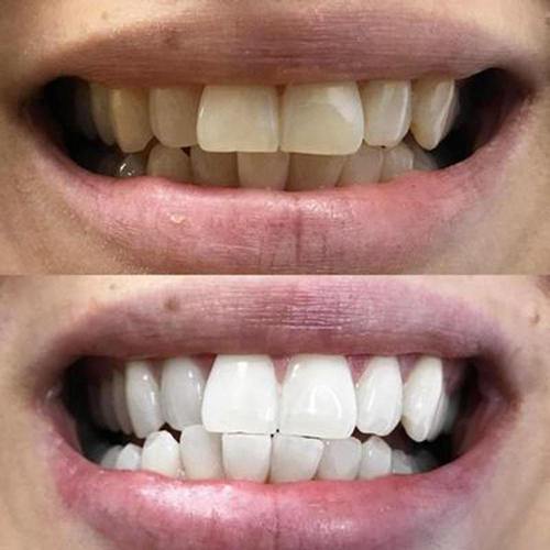 SmileBright™ Violet Strips – Direct zichtbaar wittere tanden, zonder peroxide!