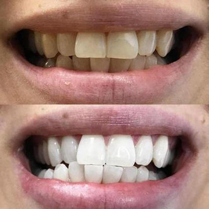 SmileBright™ Violet Strips – Direct zichtbaar wittere tanden, zonder peroxide!