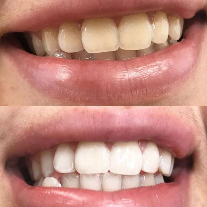 SmileBright™ Violet Strips – Direct zichtbaar wittere tanden, zonder peroxide!