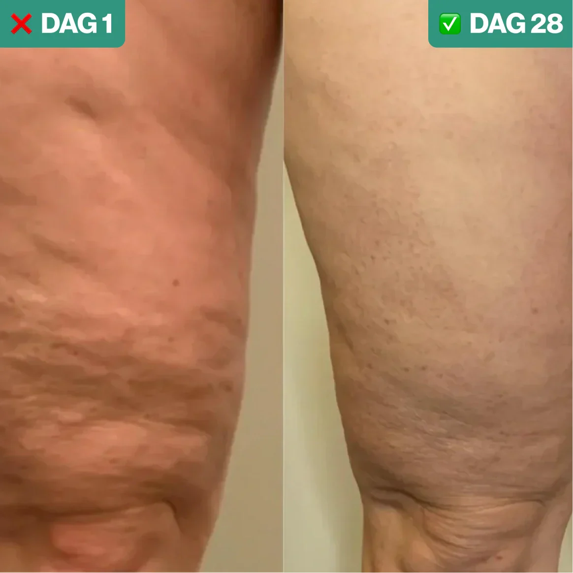 BodyLiftPro - Cellulitis  Verwijderaar & Huidversteviger